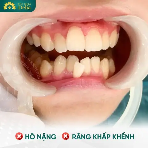 Tướng Người Răng Hô Tướng Người Răng Hô