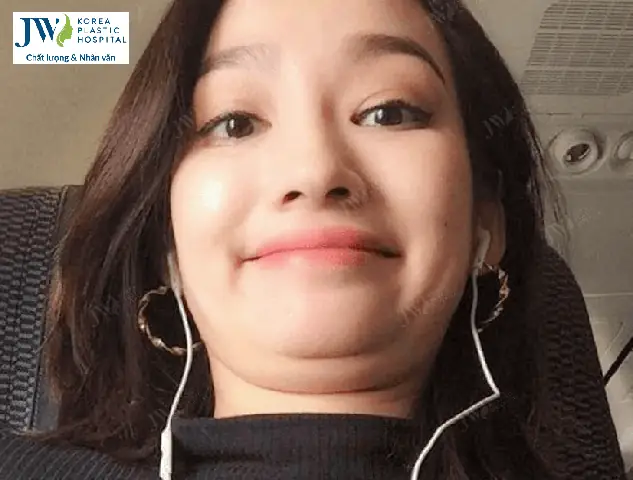 Tướng Phụ Nữ Có Nọng Cằm