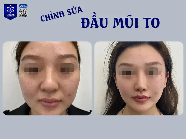Tướng Phụ Nữ Đầu Mũi To Tướng Phụ Nữ Đầu Mũi To