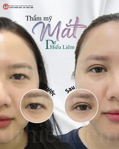 Tướng Phụ Nữ Mắt Sụp Mí Tướng Phụ Nữ Mắt Sụp Mí