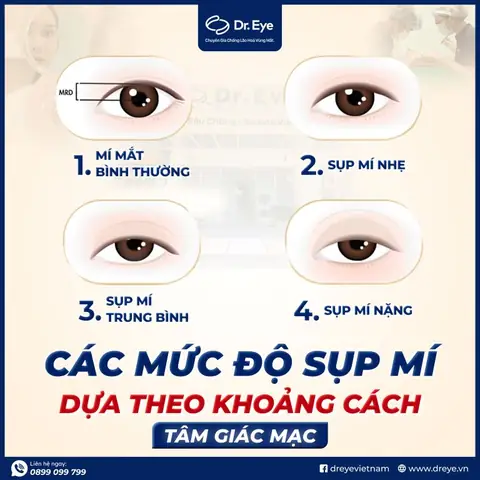 Tướng Phụ Nữ Mắt Sụp Mí Tướng Phụ Nữ Mắt Sụp Mí