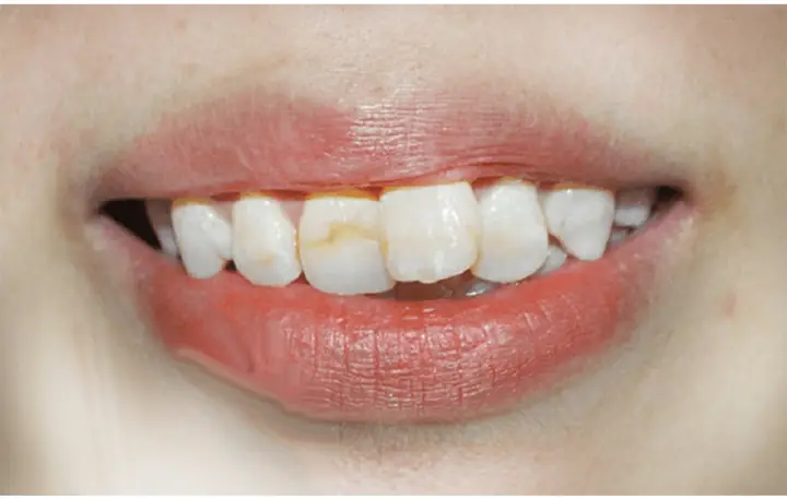 Tướng Phụ Nữ Răng Không Đều Tướng Phụ Nữ Răng Không Đều