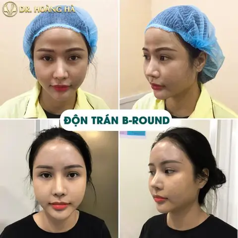 Tướng Phụ Nữ Trán Ngắn Tướng Phụ Nữ Trán Ngắn