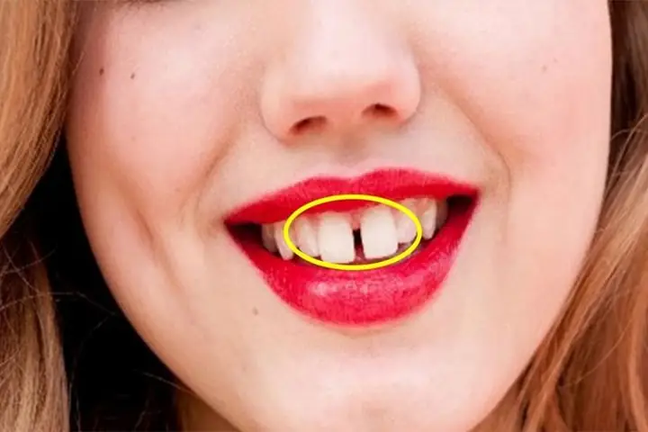 Xem Tướng Đàn Ông Răng Cửa Thưa Xem Tướng Đàn Ông Răng Cửa Thưa