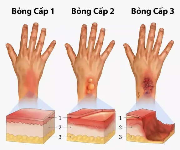 Giải Mã Điềm Báo Bị Bỏng Trước Khi Thi Và Những Kiêng Kỵ Sĩ Tử Cần Biết Giải Mã Điềm Báo Bị Bỏng Trước Khi Thi Và Những Kiêng Kỵ Sĩ Tử Cần Biết