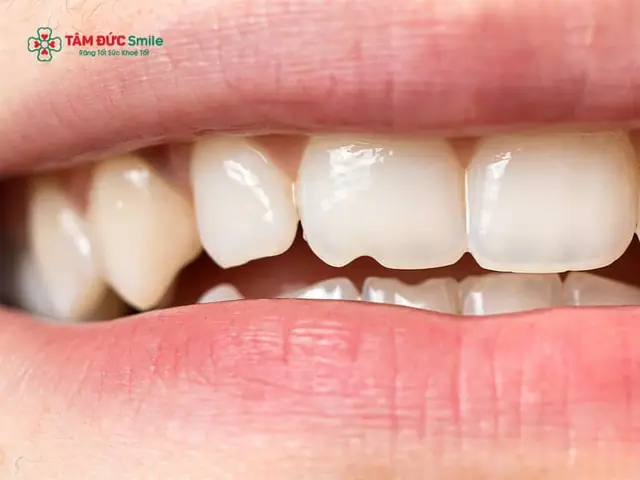 Giải Đáp Bị Mẻ Răng Hàm Dưới Điềm Gì Theo Nhân Tướng Học Và Góc Nhìn Nha Khoa Giải Đáp Bị Mẻ Răng Hàm Dưới Điềm Gì Theo Nhân Tướng Học Và Góc Nhìn Nha Khoa