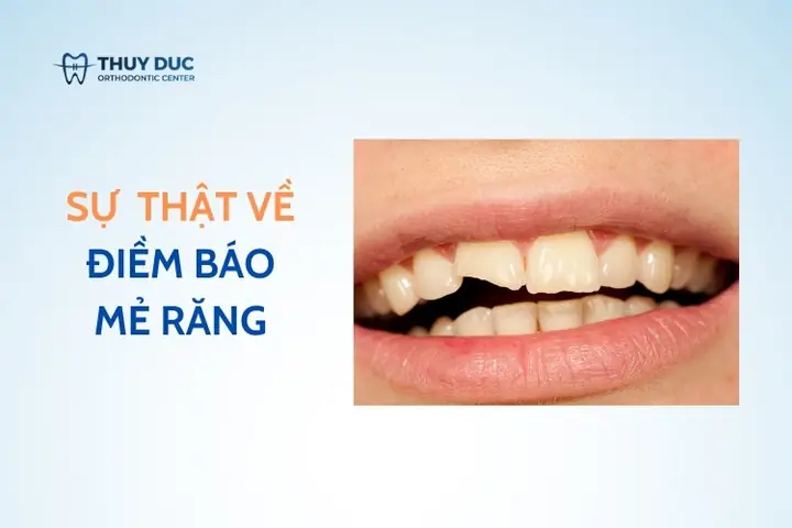 Giải Đáp Bị Mẻ Răng Hàm Dưới Điềm Gì Theo Nhân Tướng Học Và Góc Nhìn Nha Khoa Giải Đáp Bị Mẻ Răng Hàm Dưới Điềm Gì Theo Nhân Tướng Học Và Góc Nhìn Nha Khoa