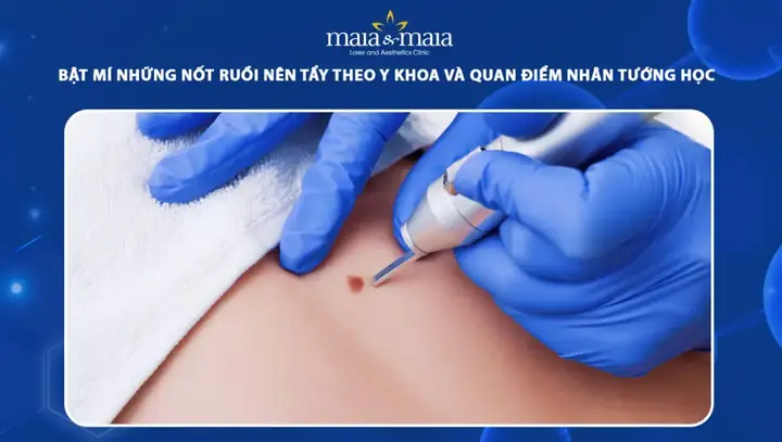 Các Vị Trí Nốt Ruồi Nên Tẩy Theo Y Khoa Và Nhân Tướng Học