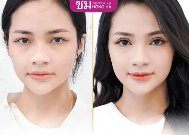 Giải Đáp Cắt Mí Có Ảnh Hưởng Tướng Số Và Vận Mệnh Theo Khoa Học Và Nhân Tướng Học