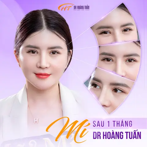 Giải Đáp Cắt Mí Có Ảnh Hưởng Tướng Số Và Vận Mệnh Theo Khoa Học Và Nhân Tướng Học