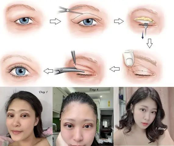 Giải Đáp: Cắt Mí Mắt Có Ảnh Hưởng Đến Tướng Số Và Vận Mệnh Không?