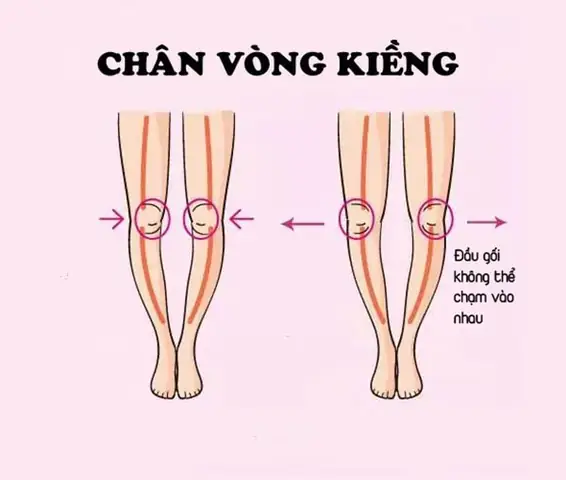 Chân Vòng Kiềng: Giải Mã Ý Nghĩa Tướng Số Nam/nữ, Nguyên Nhân Y Khoa & Cách Khắc Phục Chân Vòng Kiềng: Giải Mã Ý Nghĩa Tướng Số Nam/nữ, Nguyên Nhân Y Khoa & Cách Khắc Phục