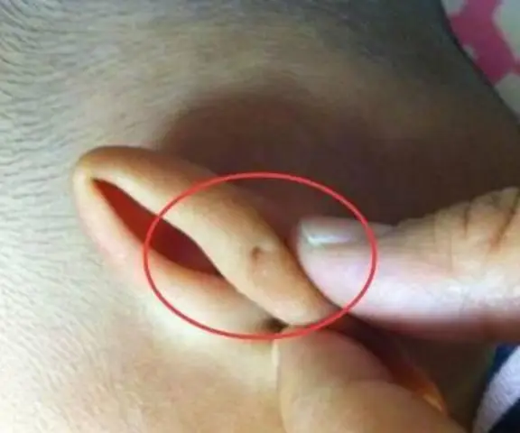 Có Lỗ Nhỏ Ở Mông Ở Trẻ Là Bệnh Gì Và Cần Làm Gì Khi Phát Hiện?