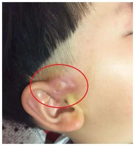 Có Lỗ Nhỏ Ở Mông Ở Trẻ Là Bệnh Gì Và Cần Làm Gì Khi Phát Hiện?