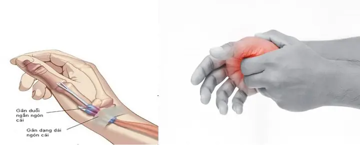 Tìm Hiểu Đau Cổ Tay Phải: Nguyên Nhân, Triệu Chứng Và Cách Chữa Trị Tìm Hiểu Đau Cổ Tay Phải: Nguyên Nhân, Triệu Chứng Và Cách Chữa Trị