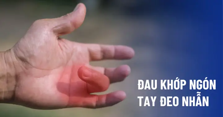 Nhận Biết Và Điều Trị Đau Khớp Ngón Tay Đeo Nhẫn: Nguyên Nhân, Dấu Hiệu Và Cách Cải Thiện