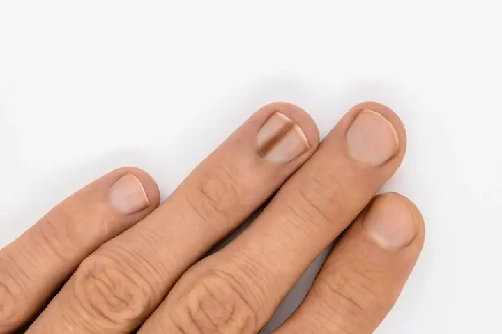 Giải Đáp Gạch Đen Nhỏ Ở Móng Tay Là Bệnh Gì Và Ý Nghĩa Cảnh Báo Sức Khỏe Giải Đáp Gạch Đen Nhỏ Ở Móng Tay Là Bệnh Gì Và Ý Nghĩa Cảnh Báo Sức Khỏe