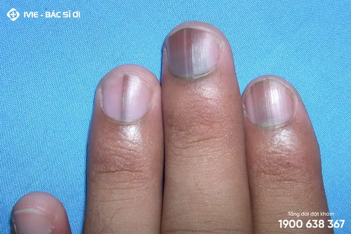 Giải Đáp Gạch Đen Nhỏ Ở Móng Tay Là Bệnh Gì Và Ý Nghĩa Cảnh Báo Sức Khỏe Giải Đáp Gạch Đen Nhỏ Ở Móng Tay Là Bệnh Gì Và Ý Nghĩa Cảnh Báo Sức Khỏe