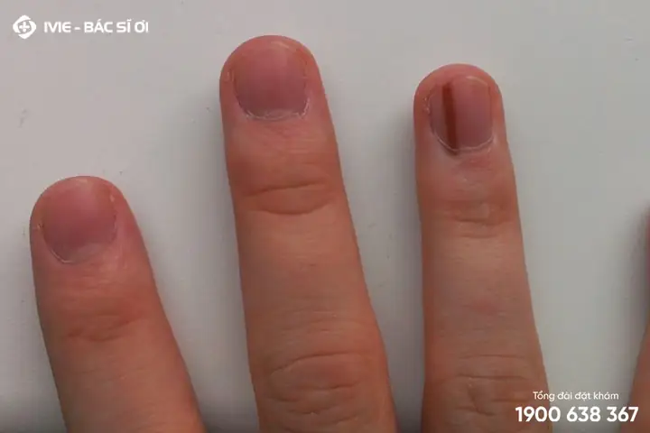 Giải Đáp Gạch Đen Nhỏ Ở Móng Tay Là Bệnh Gì Và Ý Nghĩa Cảnh Báo Sức Khỏe Giải Đáp Gạch Đen Nhỏ Ở Móng Tay Là Bệnh Gì Và Ý Nghĩa Cảnh Báo Sức Khỏe