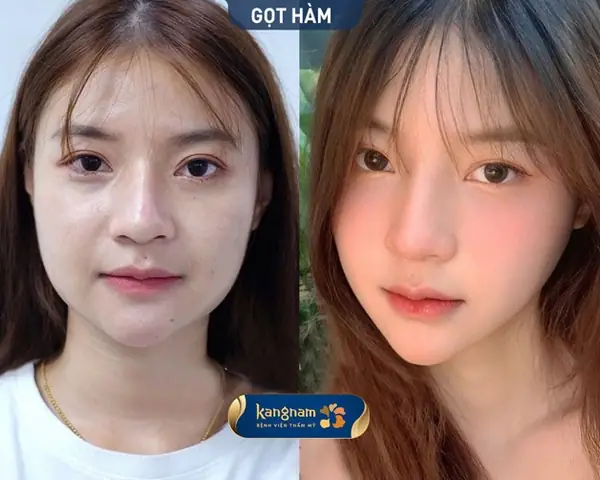 Gọt Hàm Có Phá Tướng Không Và Góc Nhìn Khoa Học Cho Người Định Phẫu Thuật Thẩm Mỹ Gọt Hàm Có Phá Tướng Không Và Góc Nhìn Khoa Học Cho Người Định Phẫu Thuật Thẩm Mỹ