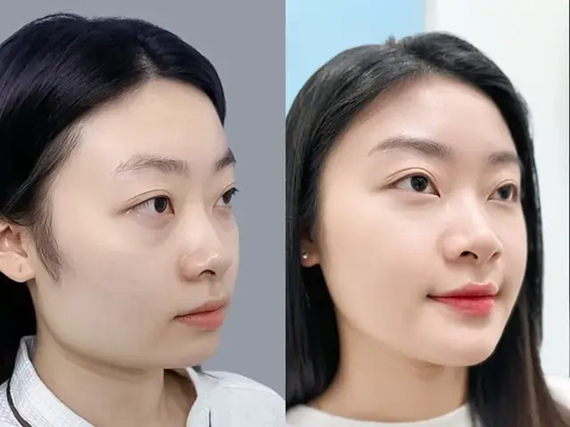 Gọt Hàm Có Phá Tướng Không Và Góc Nhìn Khoa Học Cho Người Định Phẫu Thuật Thẩm Mỹ Gọt Hàm Có Phá Tướng Không Và Góc Nhìn Khoa Học Cho Người Định Phẫu Thuật Thẩm Mỹ