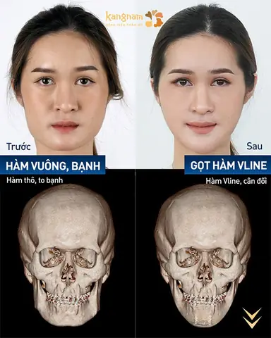 Gọt Hàm Có Phá Tướng Không Và Góc Nhìn Khoa Học Cho Người Định Phẫu Thuật Thẩm Mỹ Gọt Hàm Có Phá Tướng Không Và Góc Nhìn Khoa Học Cho Người Định Phẫu Thuật Thẩm Mỹ
