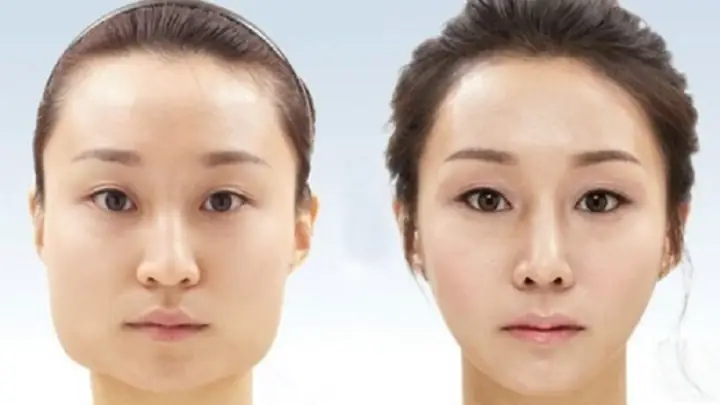 Gọt Hàm Có Phá Tướng Không Và Góc Nhìn Khoa Học Cho Người Định Phẫu Thuật Thẩm Mỹ Gọt Hàm Có Phá Tướng Không Và Góc Nhìn Khoa Học Cho Người Định Phẫu Thuật Thẩm Mỹ