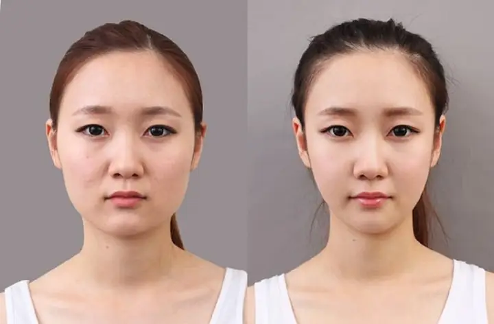 Gọt Hàm Có Phá Tướng Không Và Góc Nhìn Khoa Học Cho Người Định Phẫu Thuật Thẩm Mỹ Gọt Hàm Có Phá Tướng Không Và Góc Nhìn Khoa Học Cho Người Định Phẫu Thuật Thẩm Mỹ