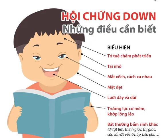 Xem Hình Ảnh Bệnh Down: Nhận Diện Dấu Hiệu Đặc Trưng Của Hội Chứng Down Cho Mẹ Bầu Xem Hình Ảnh Bệnh Down: Nhận Diện Dấu Hiệu Đặc Trưng Của Hội Chứng Down Cho Mẹ Bầu
