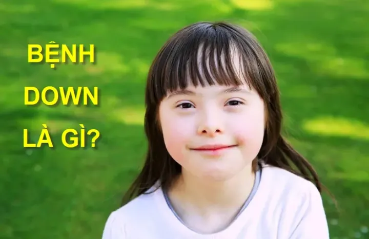 Xem Hình Ảnh Bệnh Down: Nhận Diện Dấu Hiệu Đặc Trưng Của Hội Chứng Down Cho Mẹ Bầu Xem Hình Ảnh Bệnh Down: Nhận Diện Dấu Hiệu Đặc Trưng Của Hội Chứng Down Cho Mẹ Bầu