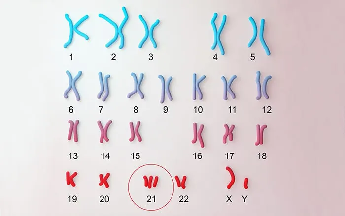 Xem Hình Ảnh Bệnh Down: Nhận Diện Dấu Hiệu Đặc Trưng Của Hội Chứng Down Cho Mẹ Bầu Xem Hình Ảnh Bệnh Down: Nhận Diện Dấu Hiệu Đặc Trưng Của Hội Chứng Down Cho Mẹ Bầu