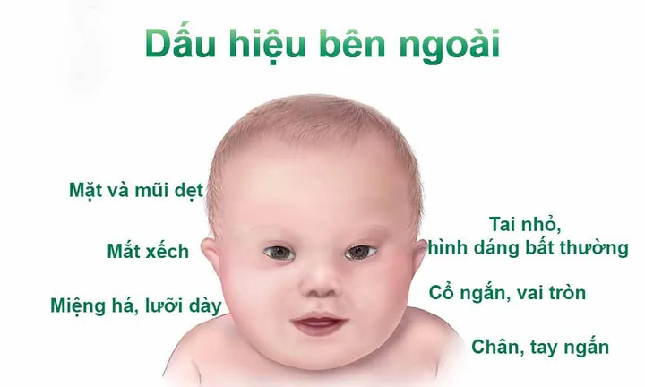Xem Hình Ảnh Bệnh Down: Nhận Diện Dấu Hiệu Đặc Trưng Của Hội Chứng Down Cho Mẹ Bầu Xem Hình Ảnh Bệnh Down: Nhận Diện Dấu Hiệu Đặc Trưng Của Hội Chứng Down Cho Mẹ Bầu