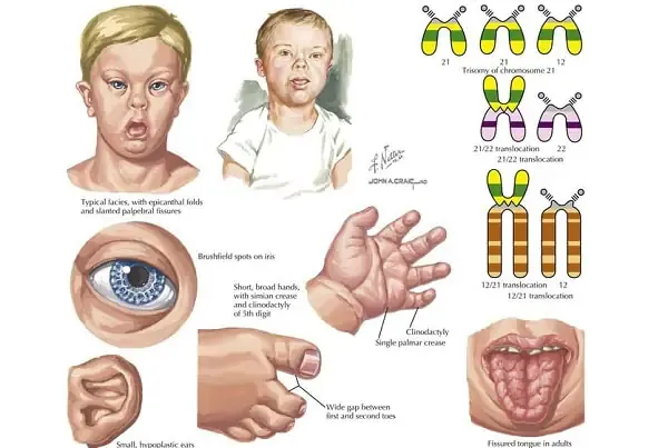 Xem Hình Ảnh Bệnh Down: Nhận Diện Dấu Hiệu Đặc Trưng Của Hội Chứng Down Cho Mẹ Bầu Xem Hình Ảnh Bệnh Down: Nhận Diện Dấu Hiệu Đặc Trưng Của Hội Chứng Down Cho Mẹ Bầu