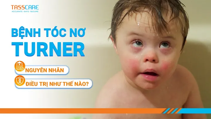 Xem Hình Ảnh Và Các Đặc Điểm Ngoại Hình (meronymy) Của Bệnh Turner Ở Trẻ Em Gái