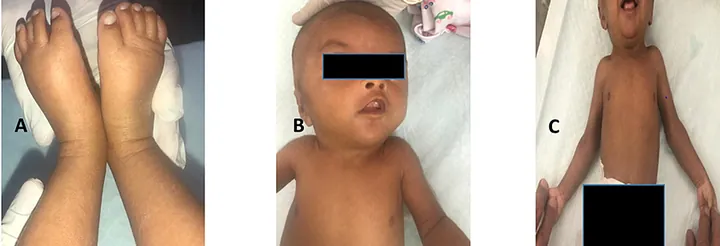 Xem Hình Ảnh Và Các Đặc Điểm Ngoại Hình (meronymy) Của Bệnh Turner Ở Trẻ Em Gái