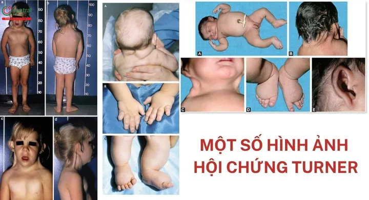 Xem Hình Ảnh Và Các Đặc Điểm Ngoại Hình (meronymy) Của Bệnh Turner Ở Trẻ Em Gái