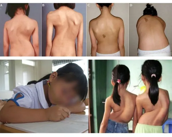 Xem Hình Ảnh Và Các Đặc Điểm Ngoại Hình (meronymy) Của Bệnh Turner Ở Trẻ Em Gái