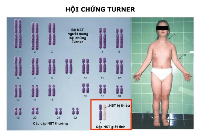 Xem Hình Ảnh Và Các Đặc Điểm Ngoại Hình (meronymy) Của Bệnh Turner Ở Trẻ Em Gái