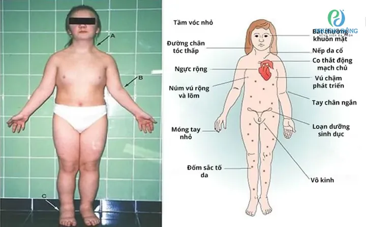 Xem Hình Ảnh Và Các Đặc Điểm Ngoại Hình (meronymy) Của Bệnh Turner Ở Trẻ Em Gái