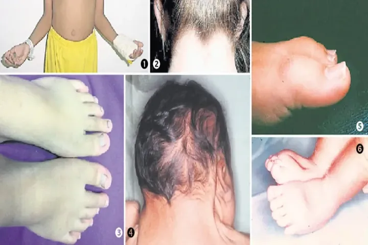 Xem Hình Ảnh Và Các Đặc Điểm Ngoại Hình (meronymy) Của Bệnh Turner Ở Trẻ Em Gái
