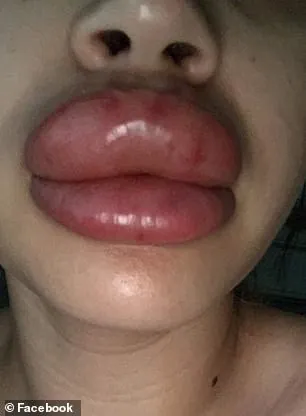 Xem Hình Ảnh Bơm Môi Thực Tế Và Rủi Ro Kèm Giải Pháp Tiêm Filler Môi Cho Phái Đẹp Xem Hình Ảnh Bơm Môi Thực Tế Và Rủi Ro Kèm Giải Pháp Tiêm Filler Môi Cho Phái Đẹp