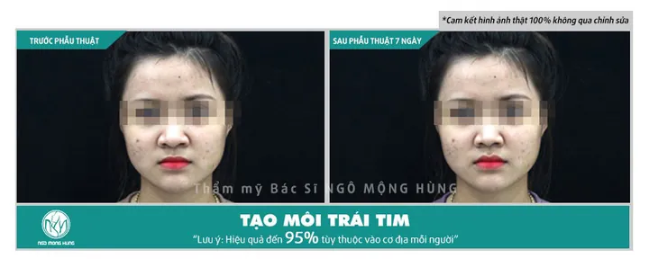 Xem Hình Ảnh Bơm Môi Thực Tế Và Rủi Ro Kèm Giải Pháp Tiêm Filler Môi Cho Phái Đẹp Xem Hình Ảnh Bơm Môi Thực Tế Và Rủi Ro Kèm Giải Pháp Tiêm Filler Môi Cho Phái Đẹp