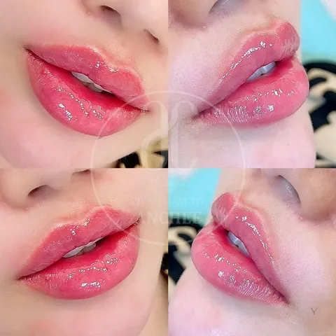 Xem Hình Ảnh Bơm Môi Thực Tế Và Rủi Ro Kèm Giải Pháp Tiêm Filler Môi Cho Phái Đẹp Xem Hình Ảnh Bơm Môi Thực Tế Và Rủi Ro Kèm Giải Pháp Tiêm Filler Môi Cho Phái Đẹp