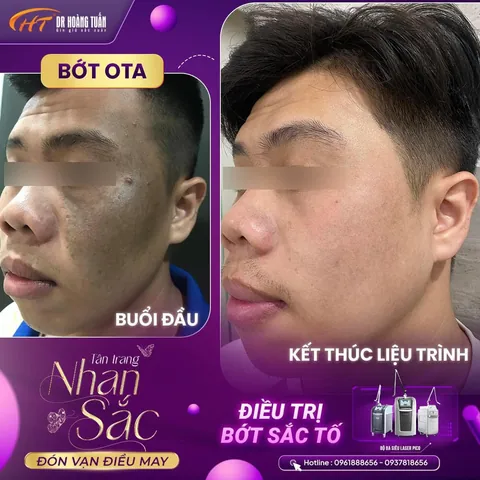 Xem Hình Ảnh Bớt Hori (nevus Hori) Và Phân Biệt Với Nám Má Cho Người Bệnh Xem Hình Ảnh Bớt Hori (nevus Hori) Và Phân Biệt Với Nám Má Cho Người Bệnh
