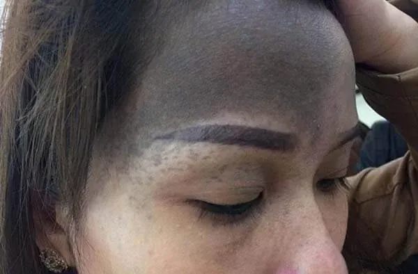 Xem Hình Ảnh Bớt Hori (nevus Hori) Và Phân Biệt Với Nám Má Cho Người Bệnh Xem Hình Ảnh Bớt Hori (nevus Hori) Và Phân Biệt Với Nám Má Cho Người Bệnh