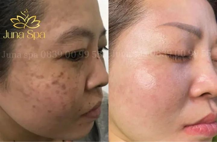 Xem Hình Ảnh Bớt Hori (nevus Hori) Và Phân Biệt Với Nám Má Cho Người Bệnh Xem Hình Ảnh Bớt Hori (nevus Hori) Và Phân Biệt Với Nám Má Cho Người Bệnh