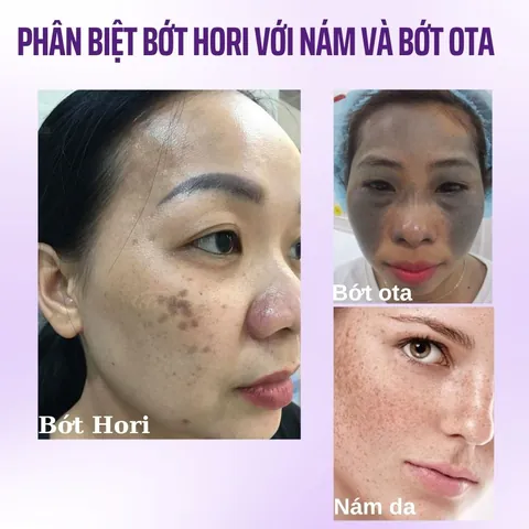 Xem Hình Ảnh Bớt Hori (nevus Hori) Và Phân Biệt Với Nám Má Cho Người Bệnh Xem Hình Ảnh Bớt Hori (nevus Hori) Và Phân Biệt Với Nám Má Cho Người Bệnh