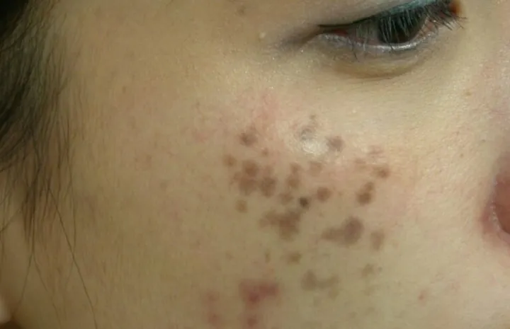 Xem Hình Ảnh Bớt Hori (nevus Hori) Và Phân Biệt Với Nám Má Cho Người Bệnh Xem Hình Ảnh Bớt Hori (nevus Hori) Và Phân Biệt Với Nám Má Cho Người Bệnh