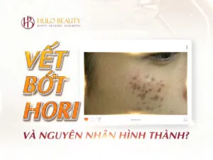 Xem Hình Ảnh Bớt Hori (nevus Hori) Và Phân Biệt Với Nám Má Cho Người Bệnh Xem Hình Ảnh Bớt Hori (nevus Hori) Và Phân Biệt Với Nám Má Cho Người Bệnh