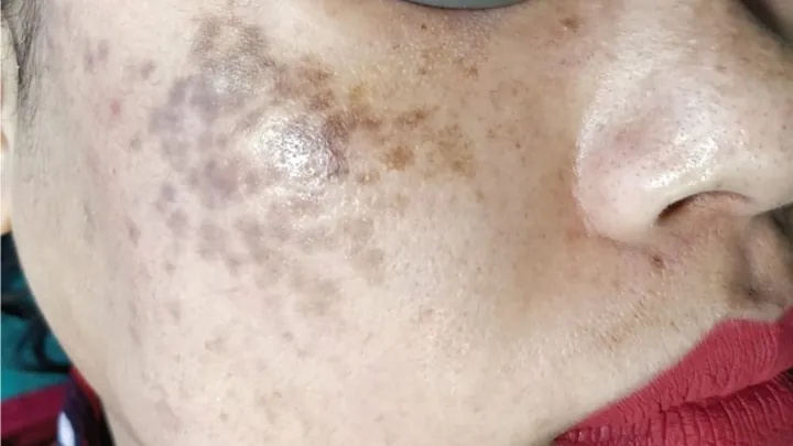 Xem Hình Ảnh Bớt Hori (nevus Hori) Và Phân Biệt Với Nám Má Cho Người Bệnh Xem Hình Ảnh Bớt Hori (nevus Hori) Và Phân Biệt Với Nám Má Cho Người Bệnh